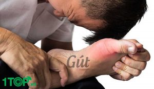 Bệnh Gout là gì, nguyên nhân, triệu chứng, cách điều trị